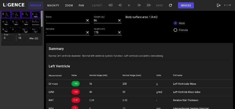 Ligence Heart Software screenshot